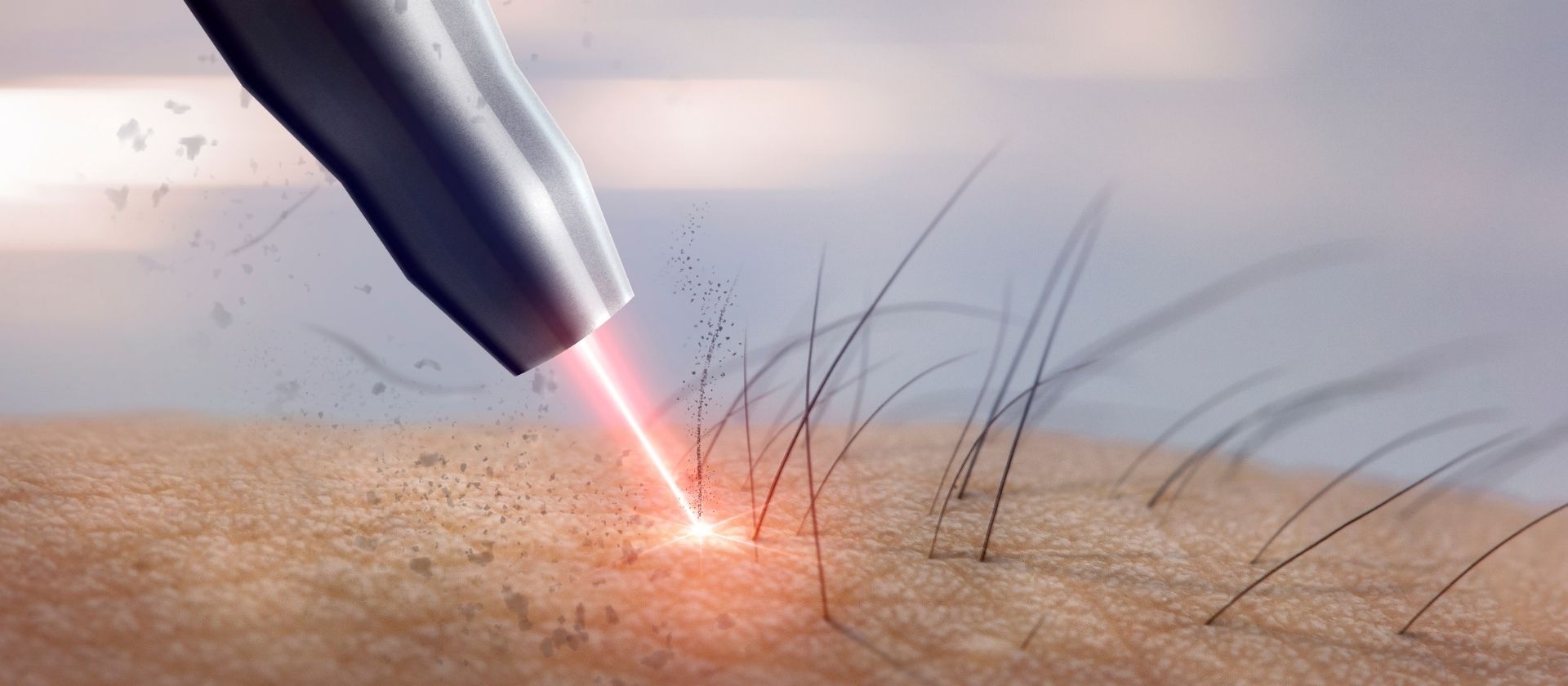 lazer-epilasyon_nasil-calisir