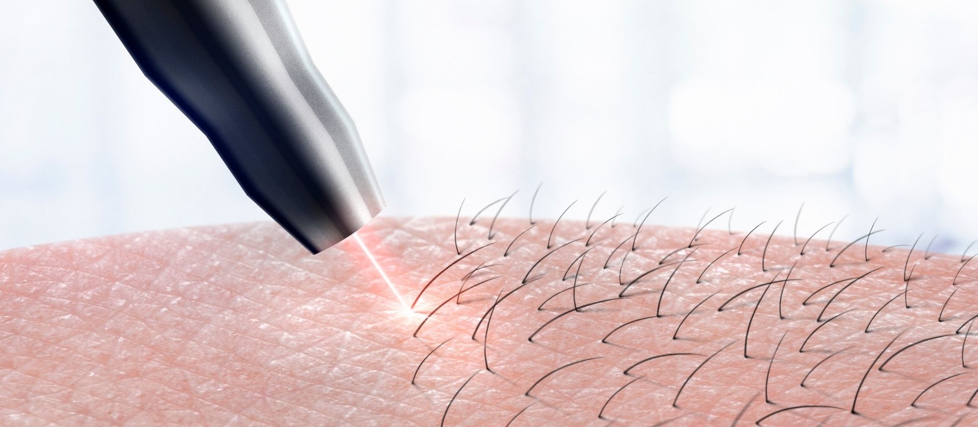 lazer-epilasyon_nedir