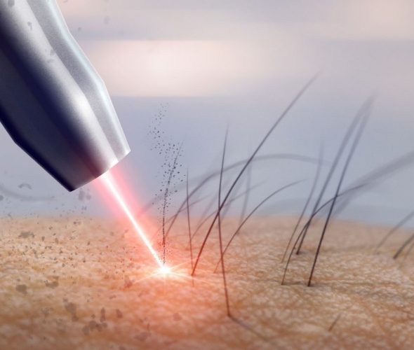 lazer-epilasyon_nasil-calisir