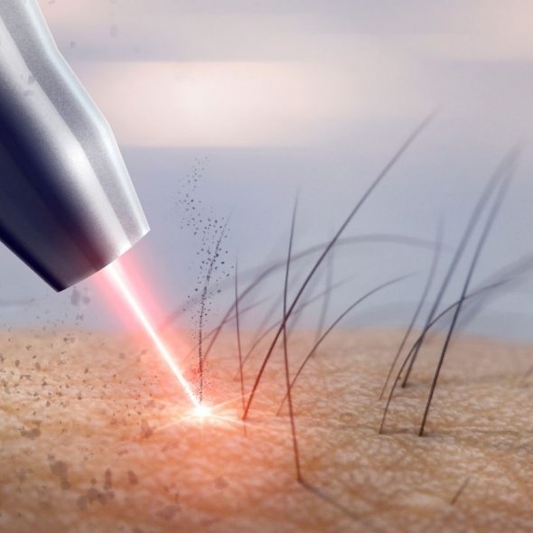 lazer-epilasyon_nasil-calisir